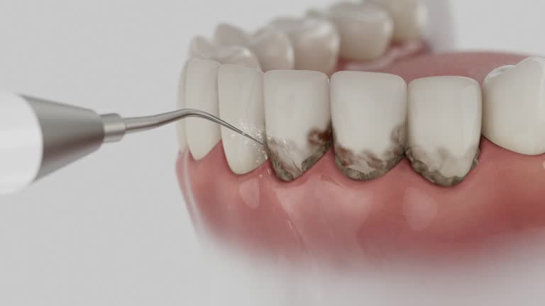 Trusted Wisdom Tooth Removal service in Flemington, NJ - Dentist Open Now